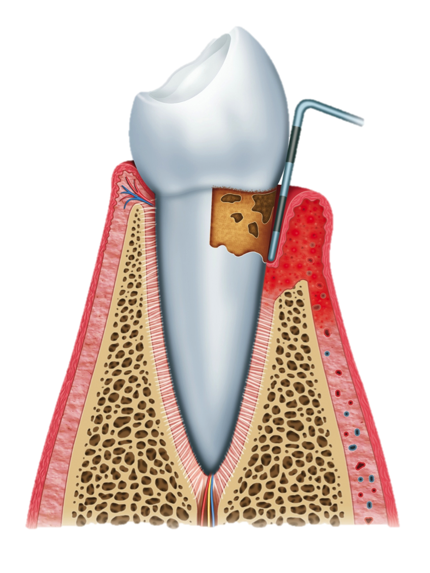 Pathologie parodontale 