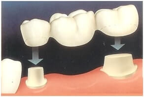 Prothèse conjointe à recouvrement partielle 